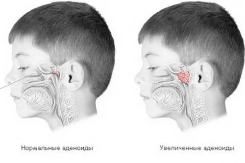 як лікувати аденоїди в горлі
