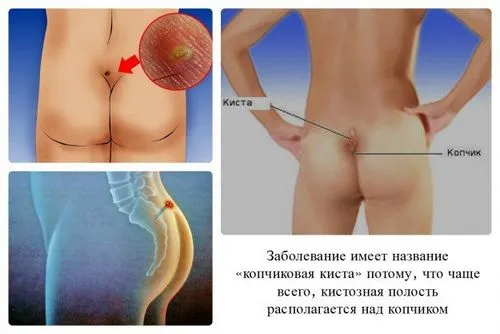 куприкова кіста