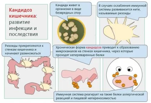 Кандидоз кишечника: види, причини, симптоми, лікування як лікувати кандидоз в кишечнику