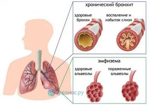 ніж лікувати у дитини сильний кашель