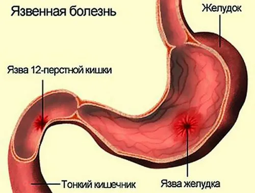 лікування картопляним соком