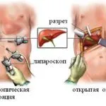 як лікувати гастрит шлунка в домашніх умовах