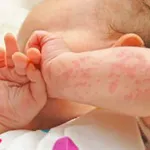 як лікувати кропив'янку у дітей