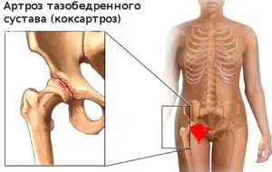 коксартроз 3 ступеня