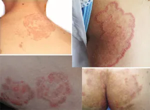 крем для псоріазу попи
