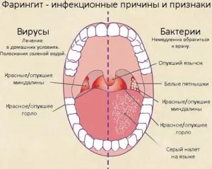 як лікувати фарингіт маслом обліпихи
