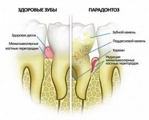 як лікувати ясна народна медицина