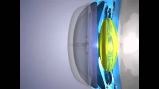 як лікувати короткозорість без операції