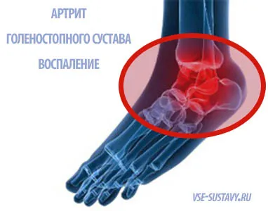 як лікувати гомілковостопний суглоб