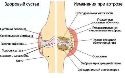 лікування артрозу