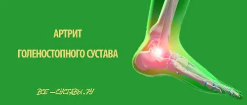 лікування артриту гомілковостопного суглоба симптоми причини