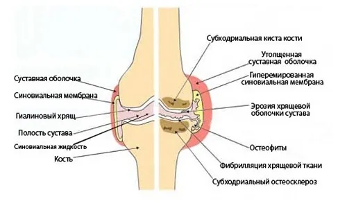 як лікувати артроз колінного суглоба в домашніх умовах