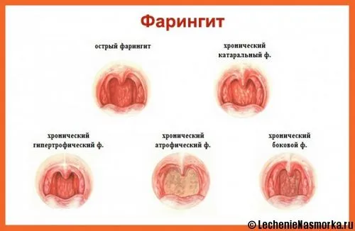 як швидко вилікувати фарингіт у домашніх умовах