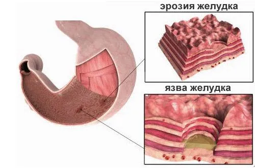 лікування ерозії шлунка народними засобами найефективніші антрального відділу що це таке травами рецепти для полегшення симптомів мед лікувальне харчування відео