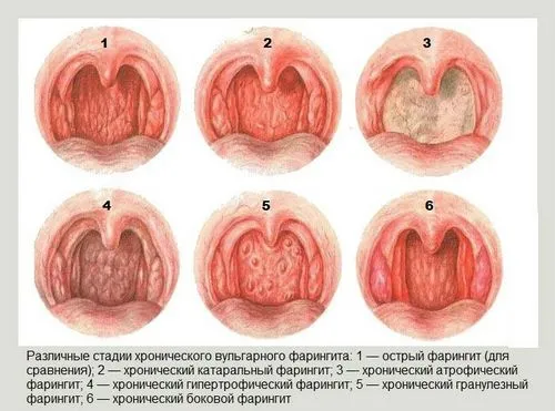 Ларингіт - фарингіт: відмінності, симптоми і лікування як лікувати ларингіт фарингіт