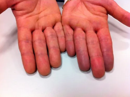 крем від варикозу на руках