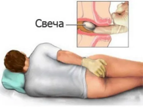 як лікувати геморой