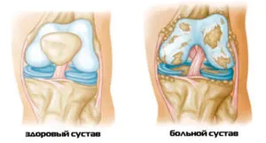 як лікувати суглоби у дітей