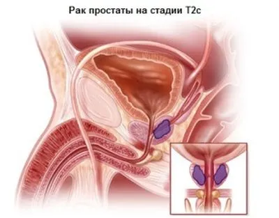 як лікувати рак 2 ступеня