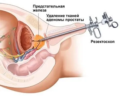як лікувати рак 2 ступеня