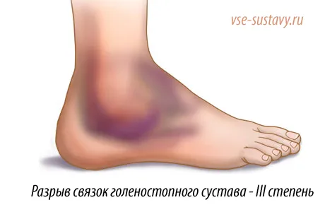 як лікувати ногу після розриву зв'язок