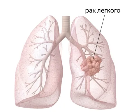 як лікувати рак легенів