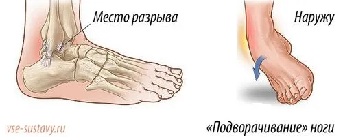 як лікувати ногу після розриву зв'язок