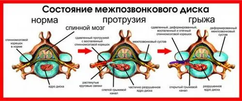 як лікувати грижу шиї