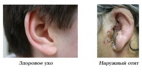 Лікування отиту як лікувати отит внутрішнього вуха