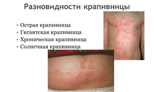 лікувати псоріаз йодом