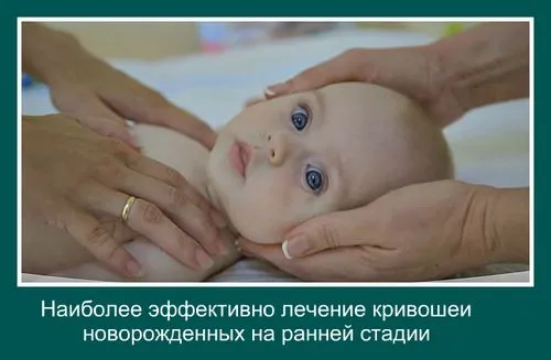 як лікувати кривошею