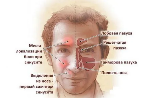 як лікувати риніт синусит