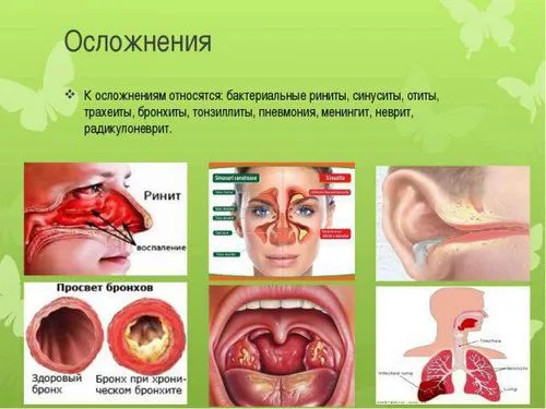 як лікувати риніт синусит