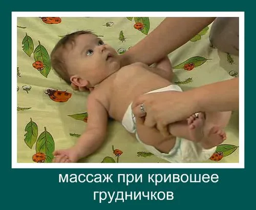 як лікувати кривошею