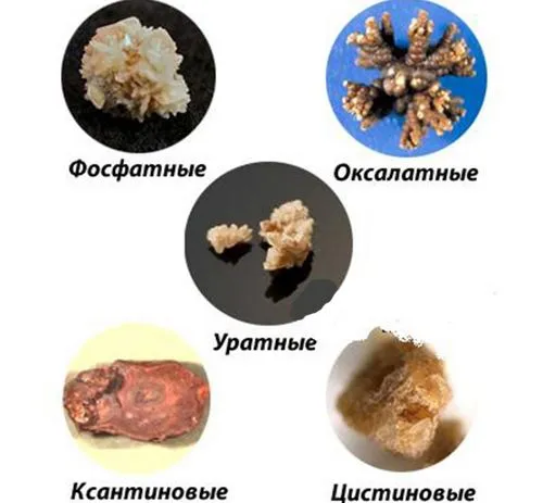 як лікувати нирки якщо є камені
