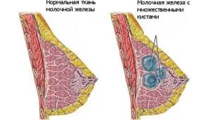 як лікувати мастопатію у новонароджених