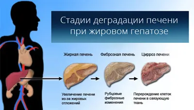 як лікувати гепатоз печінки