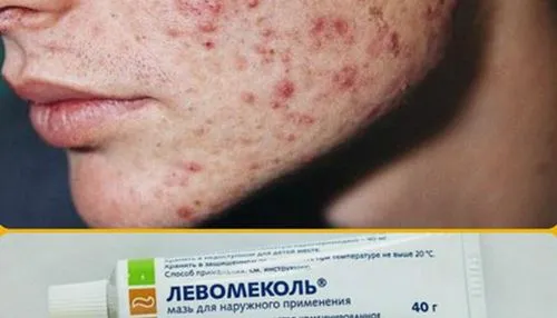 Левомеколь від прищів на обличчі: чи допомагає мазь і як її застосовувати льовомеколь від прищів