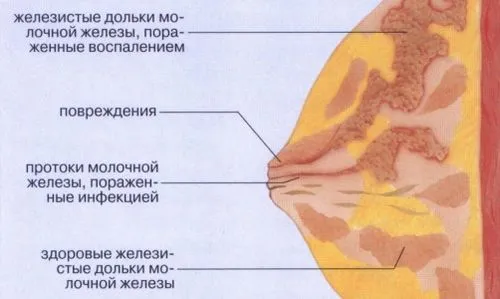 Містить - симптоми, лікування при грудному вигодовуванні, лікування в домашніх умовах як можна лікувати мастит у домашніх умовах