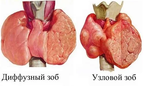 як вилікувати зоб щитовидної залози