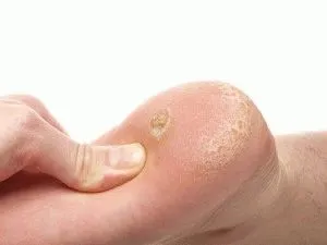 як лікувати п'ятковий мозоль