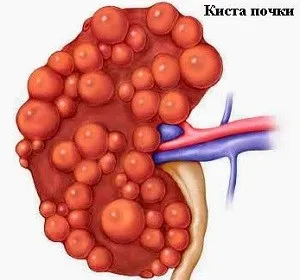 кісти нирок причини