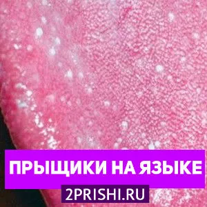 як вилікувати прищі на корені мови