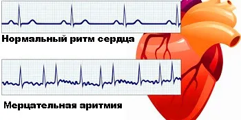 як лікувати постійну миготливу аритмію