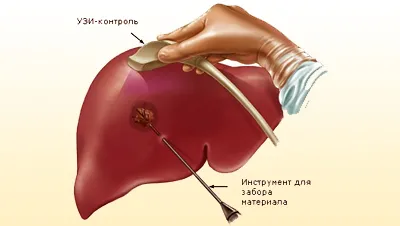 некроз печінку симптоми лікування