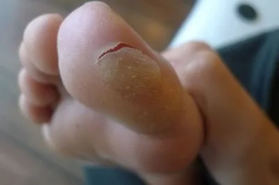 мозоль під великим пальцем ноги