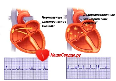 аритмія