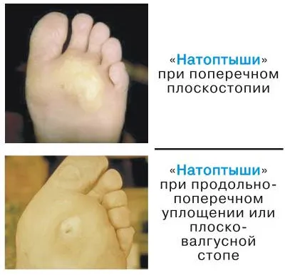 натоптиші на підошві