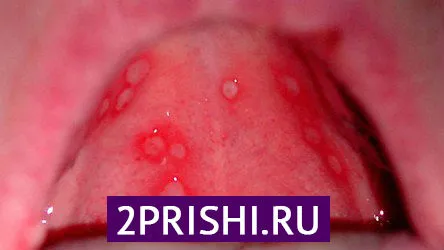 як вилікувати прищі на корені мови