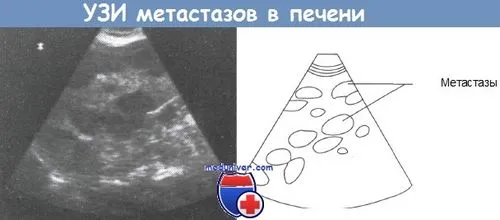 методи лікування метастазів раку в печінці